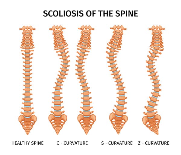 Diagram of scoliosis spinal curvature types — C, S and Z curves