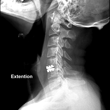 Advanced spine surgical technique