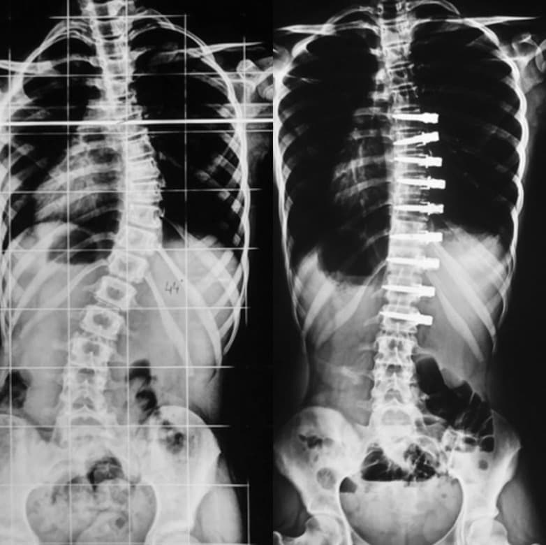 Scoliosis correction — before and after X-ray